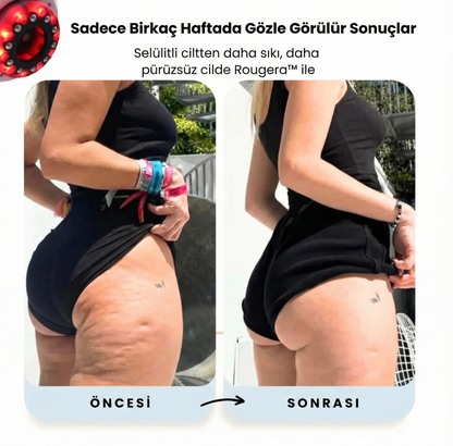 Rougera™ Yeni Nesil Selülit, Yağlanma, Lipödem giderici Masaj Aleti